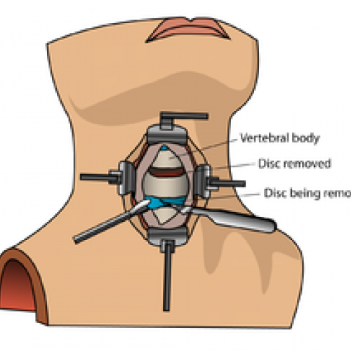 Diagram of ACDF surgery